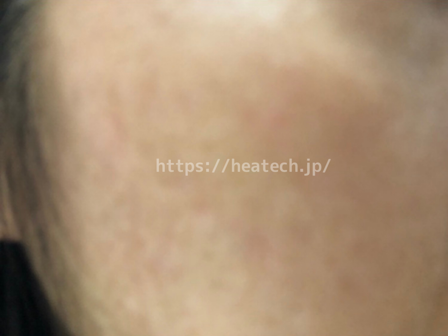 ミラブル使用6ヶ月後の頬の画像